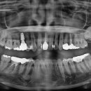 이종호의원 | 노원역 사랑니 잘뽑는 치과, 구강악안면외과 전문의가 직접 발치하는 노원 유디치과- 30,40대 발치 증례...