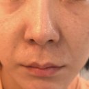 무척편안한의원 | 노원한의원 추천 중계동피부관리 1회차 후기