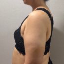 아스빅인터(주) | 수원 다이어트병원 빅사이즈 팔뚝살 지방추출 두달차 같은옷 다른핏 비교 가격