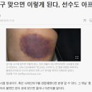 프로야구 선수들이 공 맞으면 피멍이 드는 이유 이미지