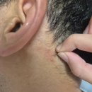 서비뇨기과의원 | 대상포진 걸렸다가 완쾌 후기(귀 뒤 통증이 대상포진?) - 치료기간, 병원 치료 비용 공개