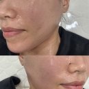 더마인 | 인계동에스테틱 온다 리프팅과 필관리 받아본 솔직 후기_더마인뷰티