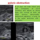 pyloric obstruction 이미지