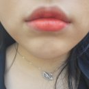 리앤영의원 | 홍대피부과 리앤영의원에서 입꼬리 입술필러 로 이뻐진입술후기!!!!