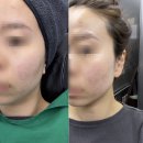 분당-서현-102 | [웨딩 피부 관리] 분당 서현 브라질리언 제모 후기, 신사 피부과전문의 온다 리프팅 6만줄 후기(w...