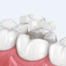 퍼즐치과기공소 이미지