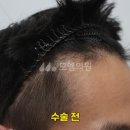 중앙헤어라인 이미지