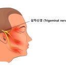 삼차 신경병증(trigeminal neuropathy) 이미지