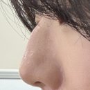 매부리코 수술 <내돈내산> 찐후기｜수술 당일부터 8일차까지 변화