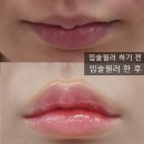 보나약국 - 청주시 서원구 모충로 93 | [강남역] 자연스러운 입술필러 후기, 입술필러 유명한 곳 추천, 가격, 멍, 붓기, 유지기간