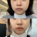 (주)티엠헬스케어 | 대구 피부과 고우리 스킨부스터 티엠버스 효과 당일부터 7일차까지 후기