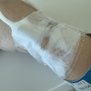 간병투게더 | 편도절제수술 7-8일차, 피덩어리 줄고 드디어 죽+아이스크림 클리어! (통증, 설사, 진료 후기 포함)