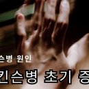 파킨슨병 초기 증상 4가지 이미지