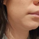 파티나인에이 | 압구정로데오피부과 박서준 리프팅 볼뉴머 600샷 미친 효과 솔직후기