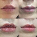 멍 | 압구정역입술필러 잘하는곳 입술필러 멍 후기 전후 내돈내산 정보