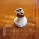 베스트라인(Bestline)치과기공소 | [상동치과] 크라운 빠짐/탈락 &#34;밥 먹다 크라운이 빠졌어요.&#34;