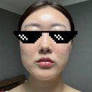 대구 울쎄라, 리쥬란힐러, 입술 입꼬리필러 수면마취 후기