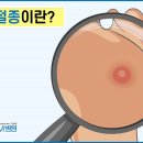 발바닥에 생긴 혹? (결절종 vs 상피성낭종) 이미지