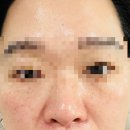 5641 | 인천여드름전문 [정은영뷰티크] 피부관리 받으러 다녀왔어요