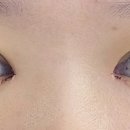 유노성형외과의원 | [25.01.22] 절개 쌍꺼풀 수술 후기 붓기 주의사항 강남 유노 성형외과 견적 수술 종류 라인 종류 마취...