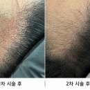 모젠헤어 | 양주 헤어라인채움 모젠smp 2차후기