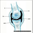 관절염 붓고 오한이 찾아온다면 통풍 의심 이미지