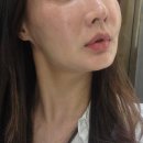 웨이브 | 논현역 피부과 힐로웨이브 중안부 볼륨 후기