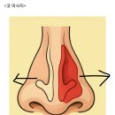 비염 20년차에 터득한 비염 다스리는 방법 이미지