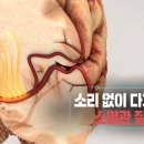 소리없이 다가온다 소혈관 질환 (KBS 20230308 방송) 이미지