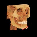 시크릿성형외과의원 | 윤곽3종+귀족수술 자가뼈이식 후기