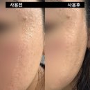 [화장품리뷰] 마미케어 율무크림 한달, 한통 사용 찐 후기/ 사용 전후 비교