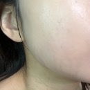 대양약국 | 신사역 에이브의원 인모드, 슈링크 레이저 리프팅 받고 온 후기