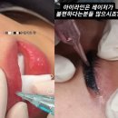 샤인룩스의원 | 에스테틱 샵에서 문신 제거? “열 번 받아도 효과 없어… 흉터와 화상 우려도”