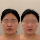 새로고침 | 청담에스테틱 디유에스테틱 프리베 청담점 새로고침 윤곽관리 후기