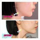 림소프트 | 마곡 피부관리 1회 관리로 이중턱 없어지는 림에스테틱 플라즈마 후기
