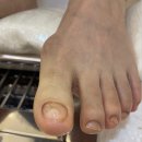 김영주피부미용 | 용인발톱무좀 효과적인 관리 김영주네일아트