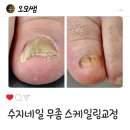 천안수지 | 청당동 수지네일 내성 무좀 발톱 스케일링 교정 후기