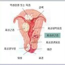 자궁선근종과 자궁근종 이미지