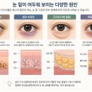 노블레스강영석성형외과의원 | 부산눈밑지방재배치, 다크서클인 줄 알았는데 원인은 따로 있을 수 있습니다.