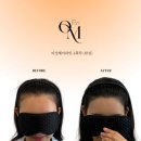 대구두피문신 달서구두피문신 전문 '온미SMP대구'에서 완성한 완벽한 헤어라인 솔루션 후기