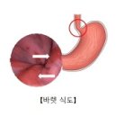 바렛식도 (Barrett's esophagus) 이미지