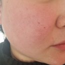 클림의원 | 홍대클림의원 리쥬란힐러 통증 및 비용 스킨보톡스과정후기