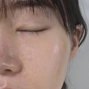 리얼픽셀 | 강남 리투오 리쥬란 비교 3개월차 리얼후기