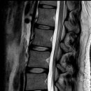 오늘 요천추mri를 찍고 경추나 흉추 문제가 확실할 것 같다는 생각을 했습니다. 이미지