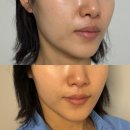 홈케어 디바이스 추천 엑쎄라피 써클샷 언박싱 1주차 후기