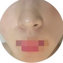 수원-1113 | [수원피부관리] 누보에스테틱 수원점