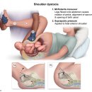 [NCLEX] 모성 분만(Labor): 조산, 어깨난산, 탯줄 탈출증 외 정리