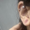 비엘성형외과의원 | [인천 부평 피지낭종 수술] 흉터 없는 제거를 원한다면 '비엘클리성형외과' 수술 후기