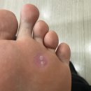 둔산태평양약국 | [제품리뷰] 티눈밴드 후기 + 콜로덤 에스(바르는 티눈약)