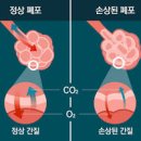 폐 섬유화 어떤 것들이 있을까 이미지